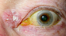 BCC MedialCanthus 1 Skin Cancers
