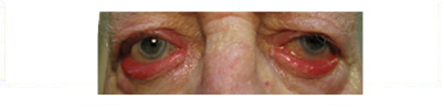Tarsal Ectropion
