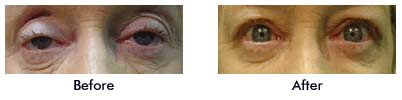 b a ptosis 04 Ptosis Image Gallery