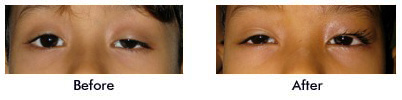ba 01 Ptosis Image Gallery