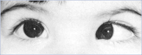 content strabismus Strabismus
