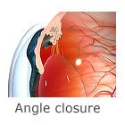 Glaucoma glaucoma 3d angle Glaucoma