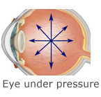 Glaucoma glaucoma 3d pressure Glaucoma