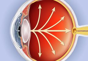eye-glaucoma