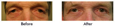 Before and After Child with Ptosis of left upper eyelid