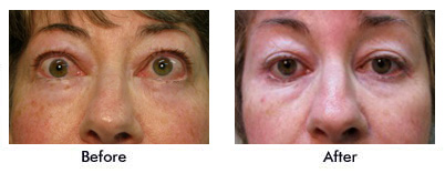 Before and After Child with Ptosis of left upper eyelid
