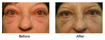 Before and After Child with Ptosis of left upper eyelid