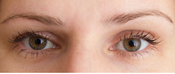 5 Causes Of A Droopy Eyelid Ptosis Peter Martin Ophthamology